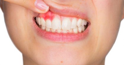 歯茎が腫れる病気と歯周病が原因だったときの対処法 歯周病治療なら東京国際クリニック 歯科