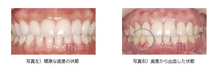 出血すると歯周病が進行している可能性大