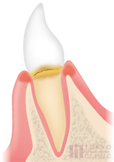 軽度歯周炎