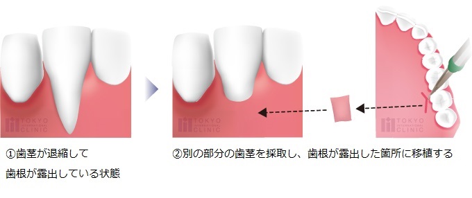 下がった歯茎の原因 歯磨きなどの治療方法とは 歯周病治療なら東京国際クリニック 歯科