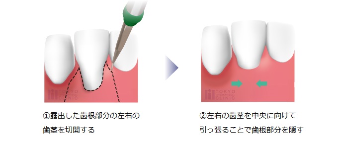 歯肉弁側方移動術