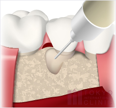 歯周組織再生療法1：エムドゲイン
