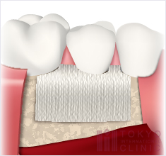 歯周組織再生療法2：GTR（歯周組織誘導法）