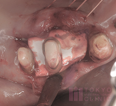東京国際クリニック/歯科が行う歯周組織再生療法「エムドゲイン」と「GTR」の併用とは