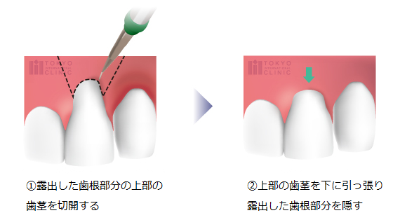 歯肉弁歯冠側移動術