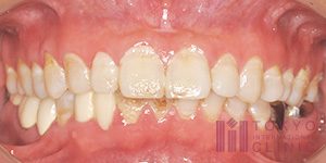 歯周病の原因とメカニズム