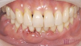 歯茎が腫れる病気：歯周病