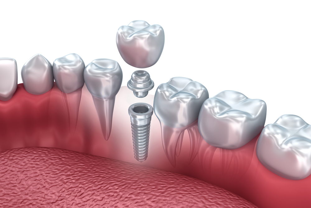 インプラントによる歯の機能回復