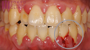 歯茎の腫れや痛みが伴うなら歯周病の可能性がある