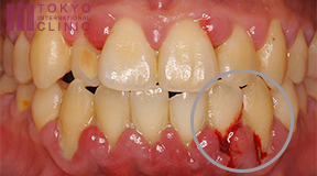 歯がしみる際に考えられる原因と効果的な対処法 歯周病の可能性 歯周病治療なら東京国際クリニック 歯科