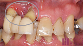 歯周病になると歯茎から膿が出る理由