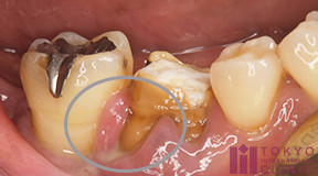 歯周病以外で排膿する4つの原因