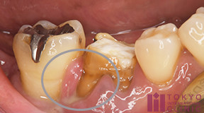 歯茎が臭い 歯根嚢胞など排膿の原因について 歯周病治療なら東京国際クリニック 歯科