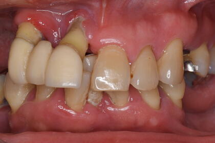 付け根 口内炎 歯茎 口内炎の症状と原因とは？特徴や治し方のポイントを部位別に詳しく解説