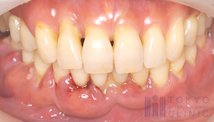 病 歯 症状 周 歯周病ははやめの治療が大切！初期症状や3つの予防法も解説