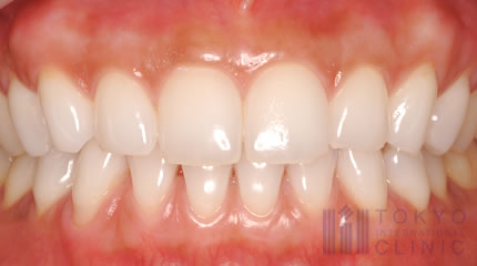 歯槽 膿 漏 治療