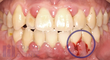 歯茎からの出血 膿 歯周病治療なら東京国際クリニック 歯科
