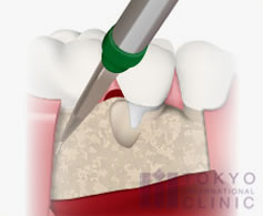 ・歯周外科手術